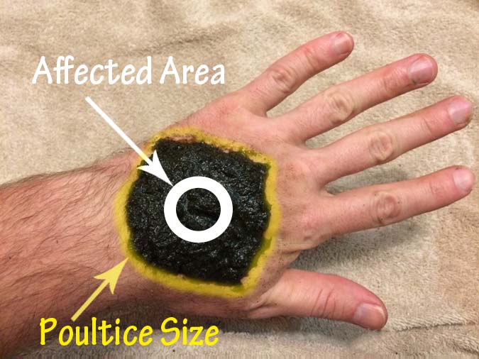 Making and Using a Poultice 3
